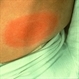 Lyme Disease